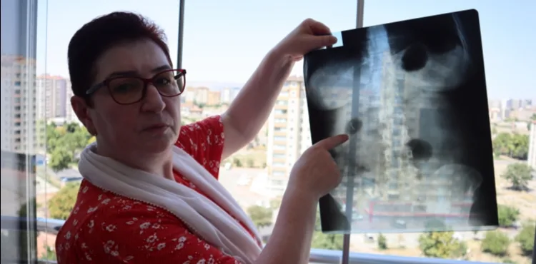 22 yıldır karnında ameliyat iğnesiyle yaşıyor