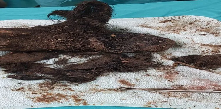 Midesinden 700 gram kıl çıktı
